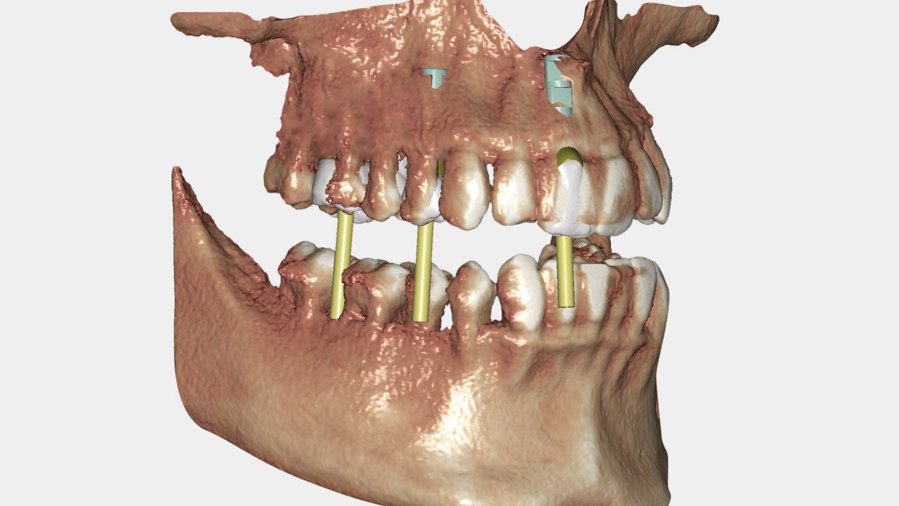 цифровая стоматология, cad cam, планирование имплантации