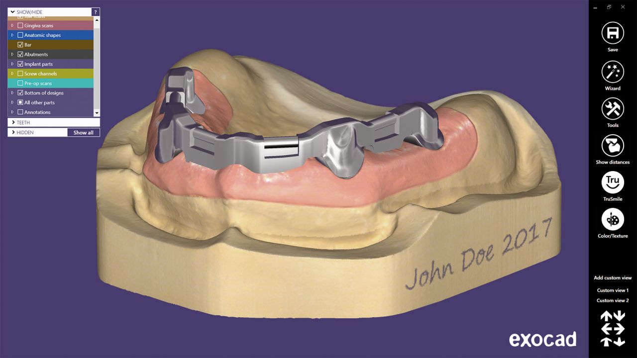 балочные конструкции, протезирование на имплантах, exocad bar, цифровая стоматология